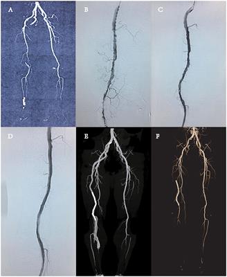 Endovascular Repair of Persistent Sciatic Artery With Limb Ischemia: A Wrong Choice?